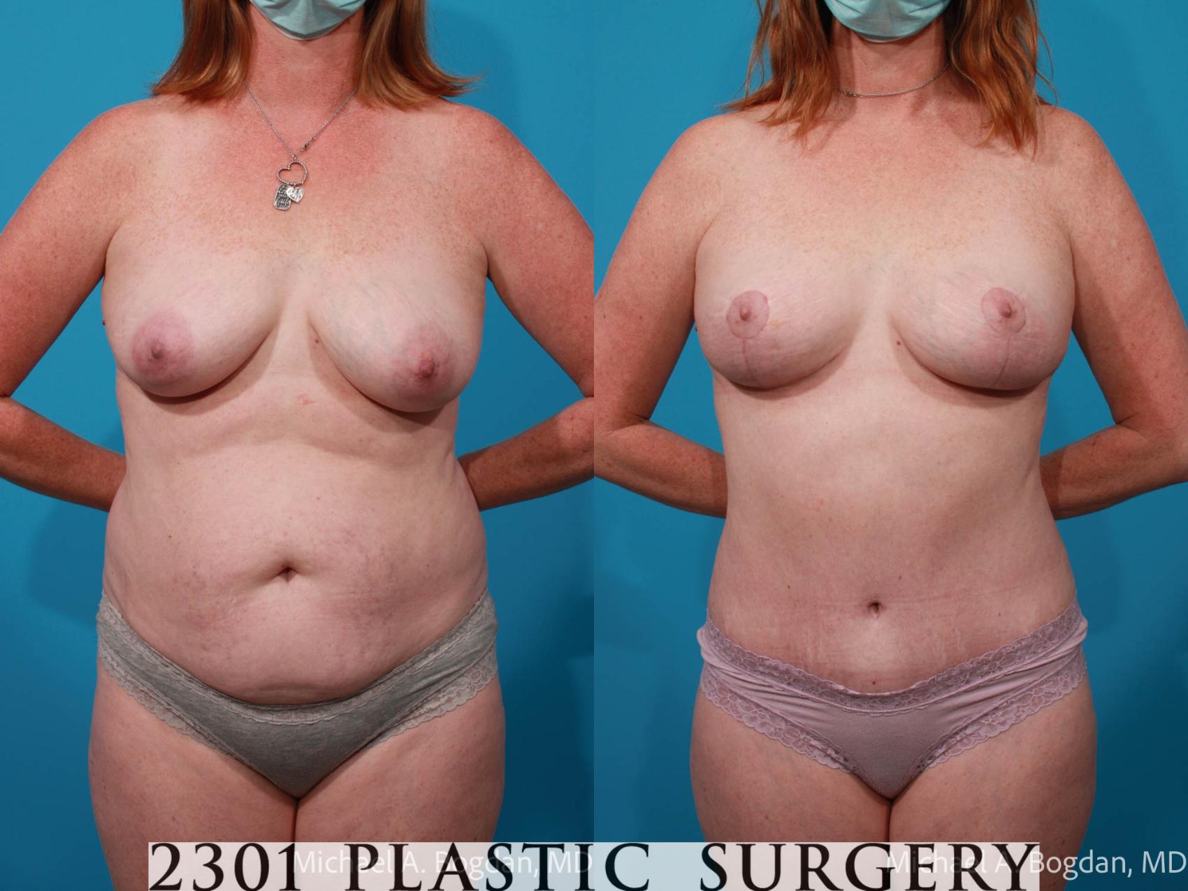 Before & After Mommy Makeover Case 685 Front View in Fort Worth, Plano, & Frisco, Texas