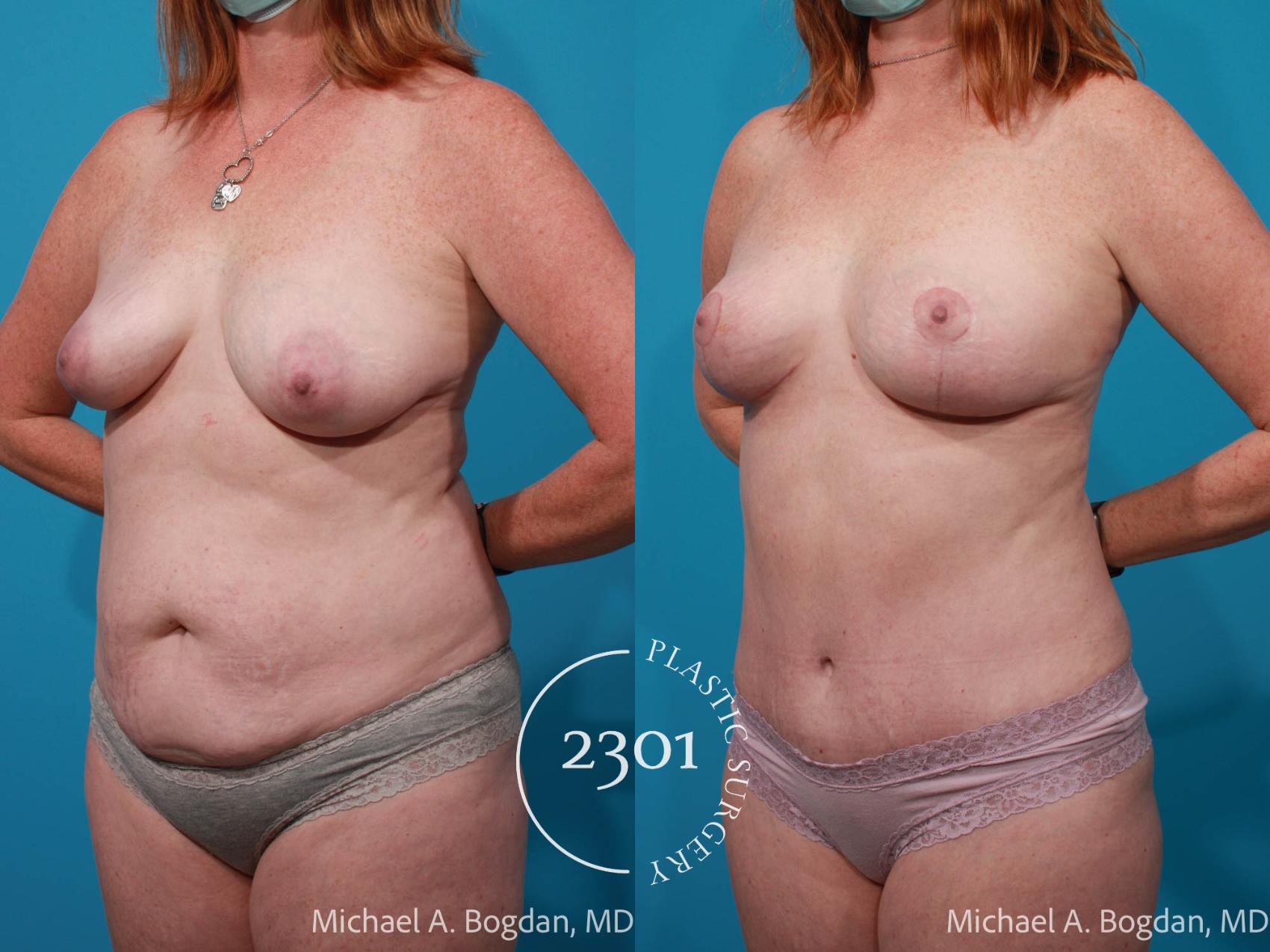 Before & After Mommy Makeover Case 685 Left Oblique View in Fort Worth, Plano, & Frisco, Texas