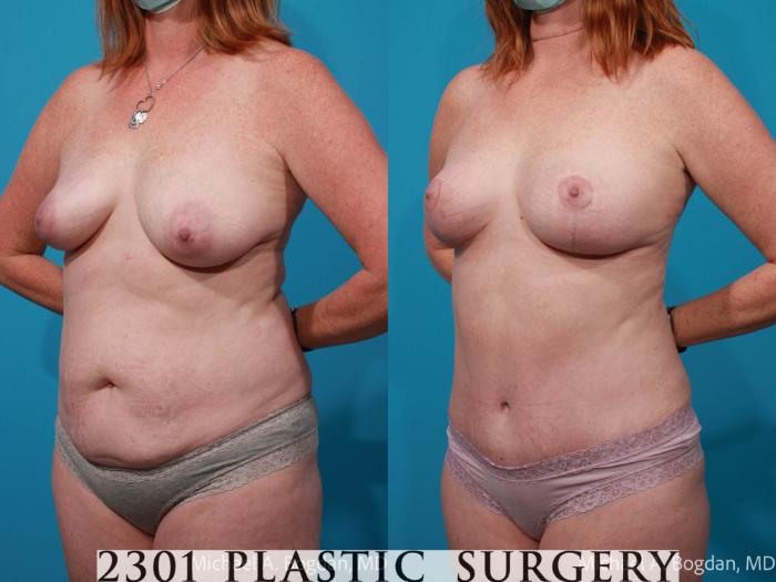 Before & After Mommy Makeover Case 685 Left Oblique View in Fort Worth, Plano, & Frisco, Texas