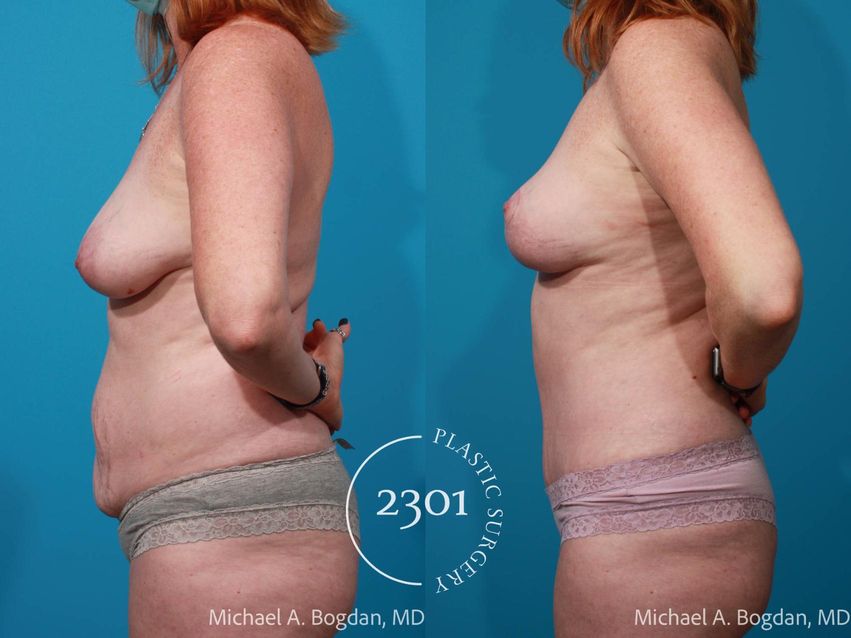 Before & After Mommy Makeover Case 685 Left Side View in Fort Worth, Plano, & Frisco, Texas