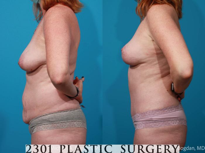 Before & After Tummy Tuck Case 685 Left Side View in Fort Worth, Plano, & Frisco, Texas