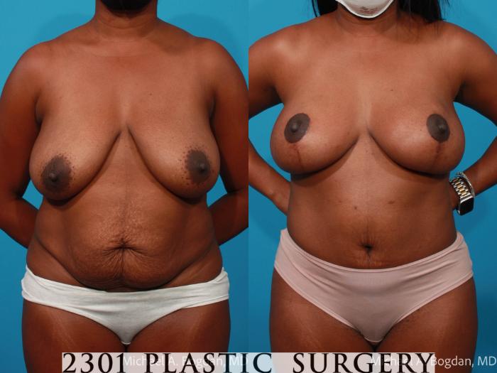 Before & After Tummy Tuck Case 686 Front View in Fort Worth, Plano, & Frisco, Texas