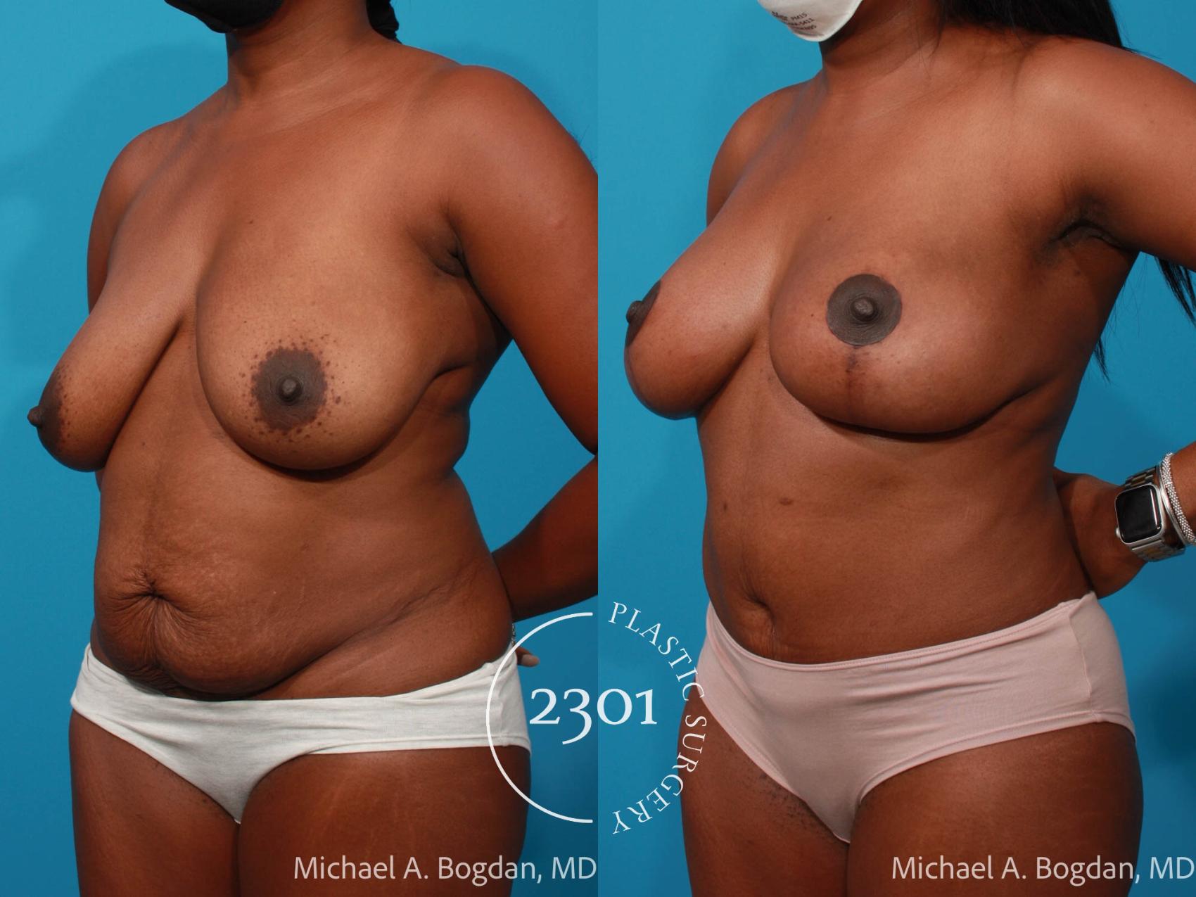Before & After Mommy Makeover Case 686 Left Oblique View in Fort Worth, Plano, & Frisco, Texas