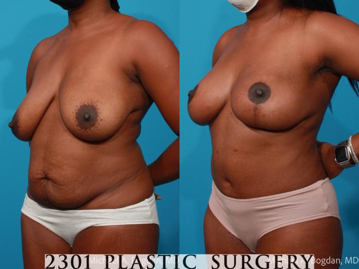 Before & After Mommy Makeover Case 686 Left Oblique View in Fort Worth, Plano, & Frisco, Texas