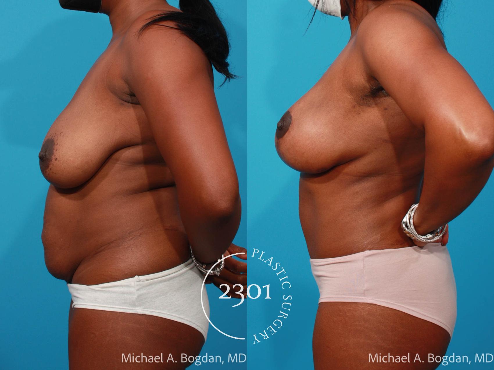 Before & After Mommy Makeover Case 686 Left Side View in Fort Worth, Plano, & Frisco, Texas