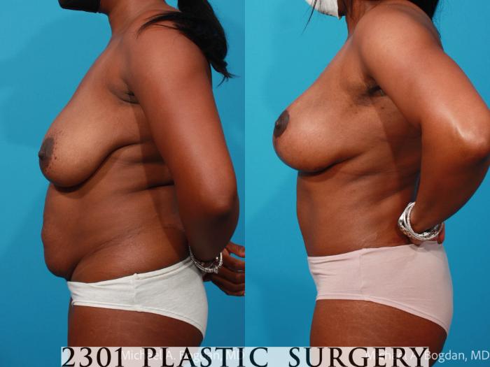 Before & After Tummy Tuck Case 686 Left Side View in Fort Worth, Plano, & Frisco, Texas