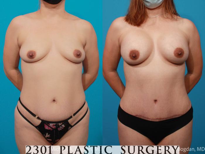 Before & After Tummy Tuck Case 693 Front View in Fort Worth, Plano, & Frisco, Texas