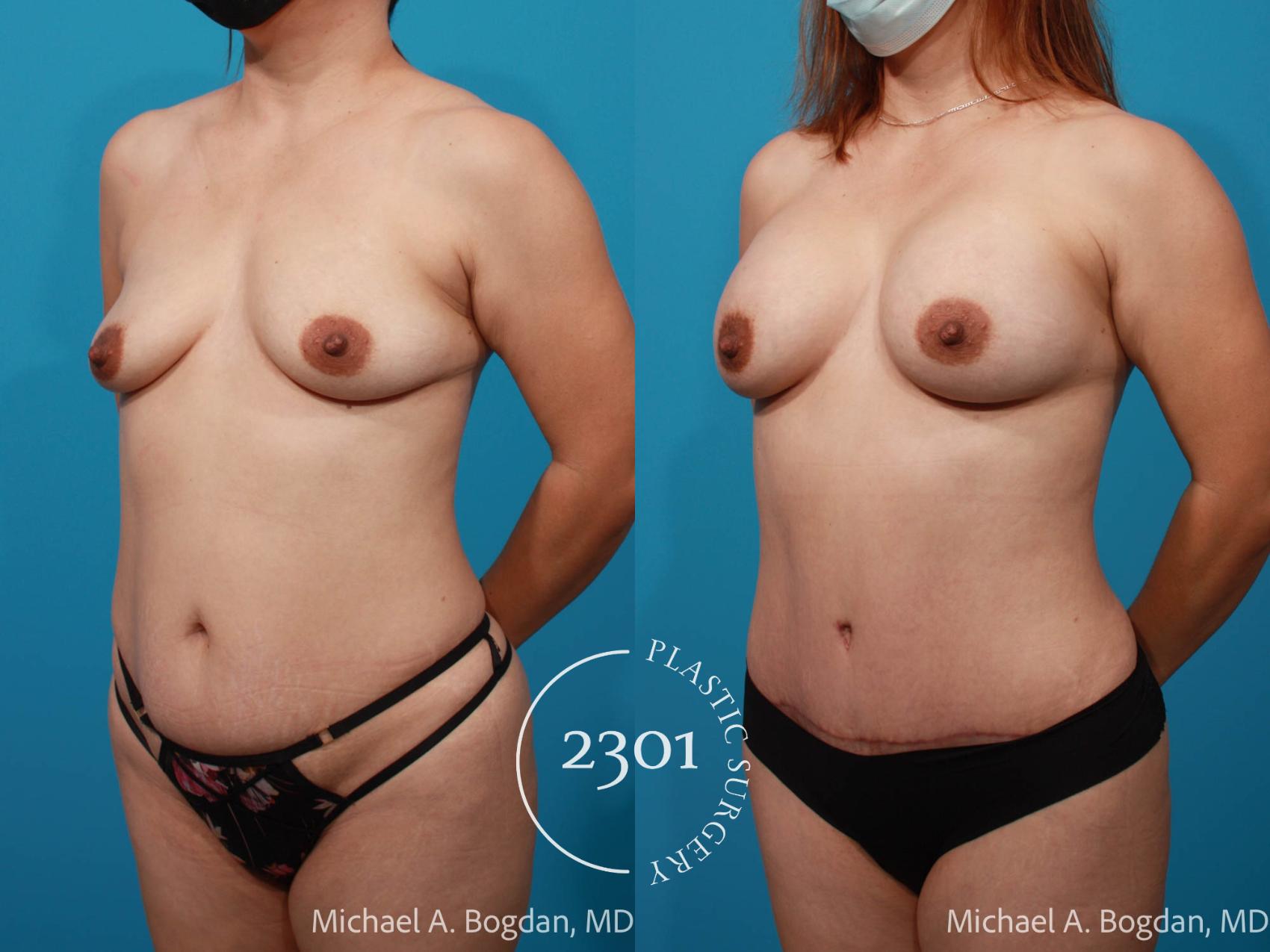 Before & After Tummy Tuck Case 693 Left Oblique View in Fort Worth, Plano, & Frisco, Texas