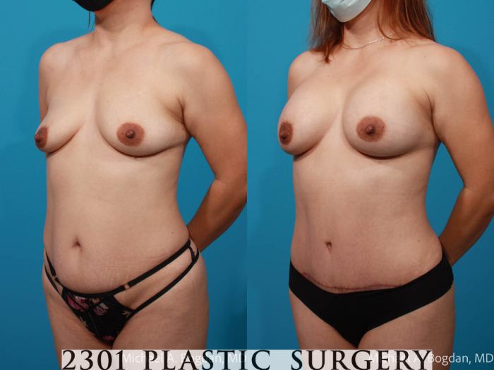 Before & After Tummy Tuck Case 693 Left Oblique View in Fort Worth, Plano, & Frisco, Texas