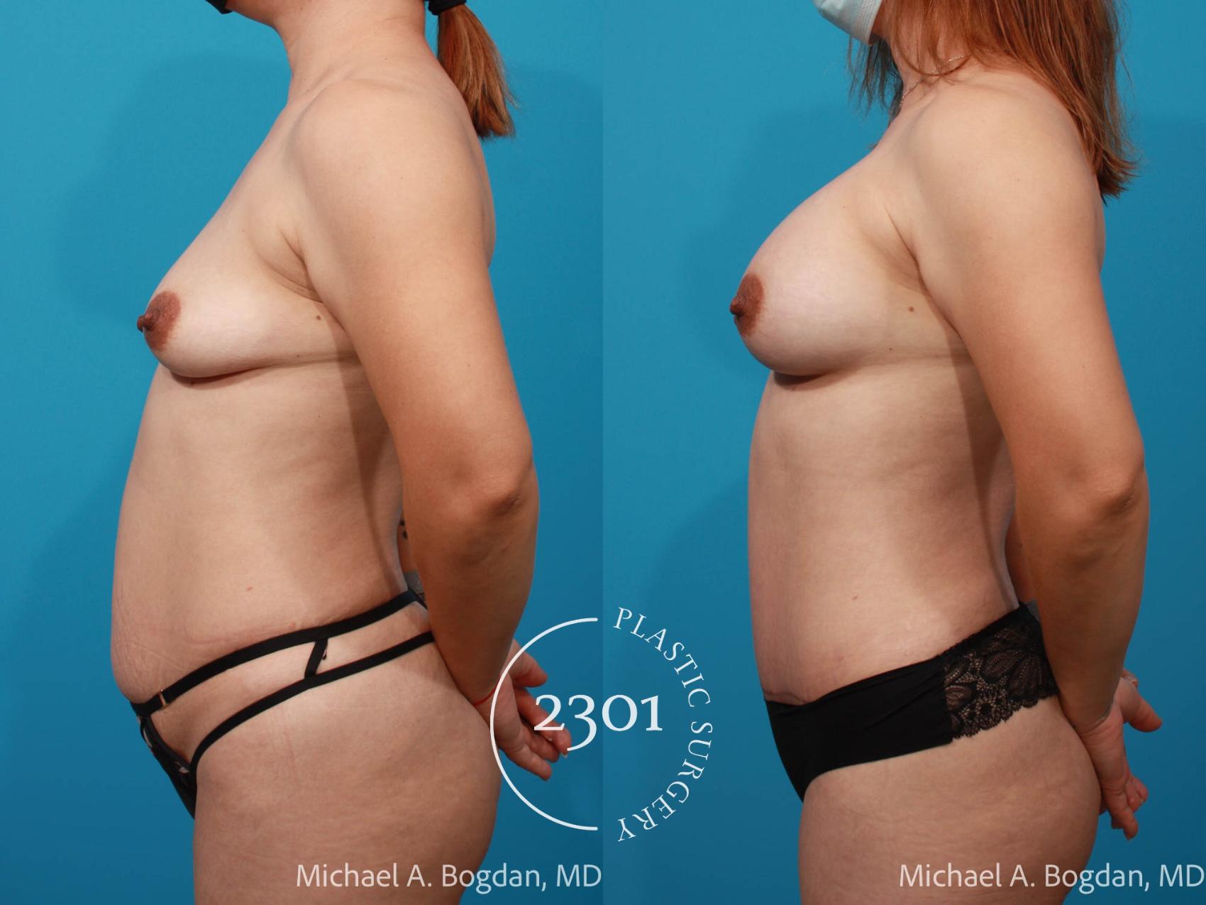 Before & After Tummy Tuck Case 693 Left Side View in Fort Worth, Plano, & Frisco, Texas