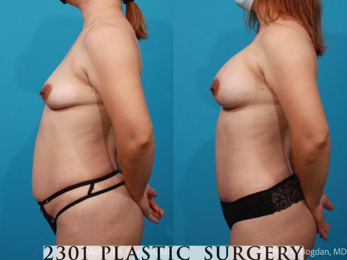 Before & After Tummy Tuck Case 693 Left Side View in Fort Worth, Plano, & Frisco, Texas