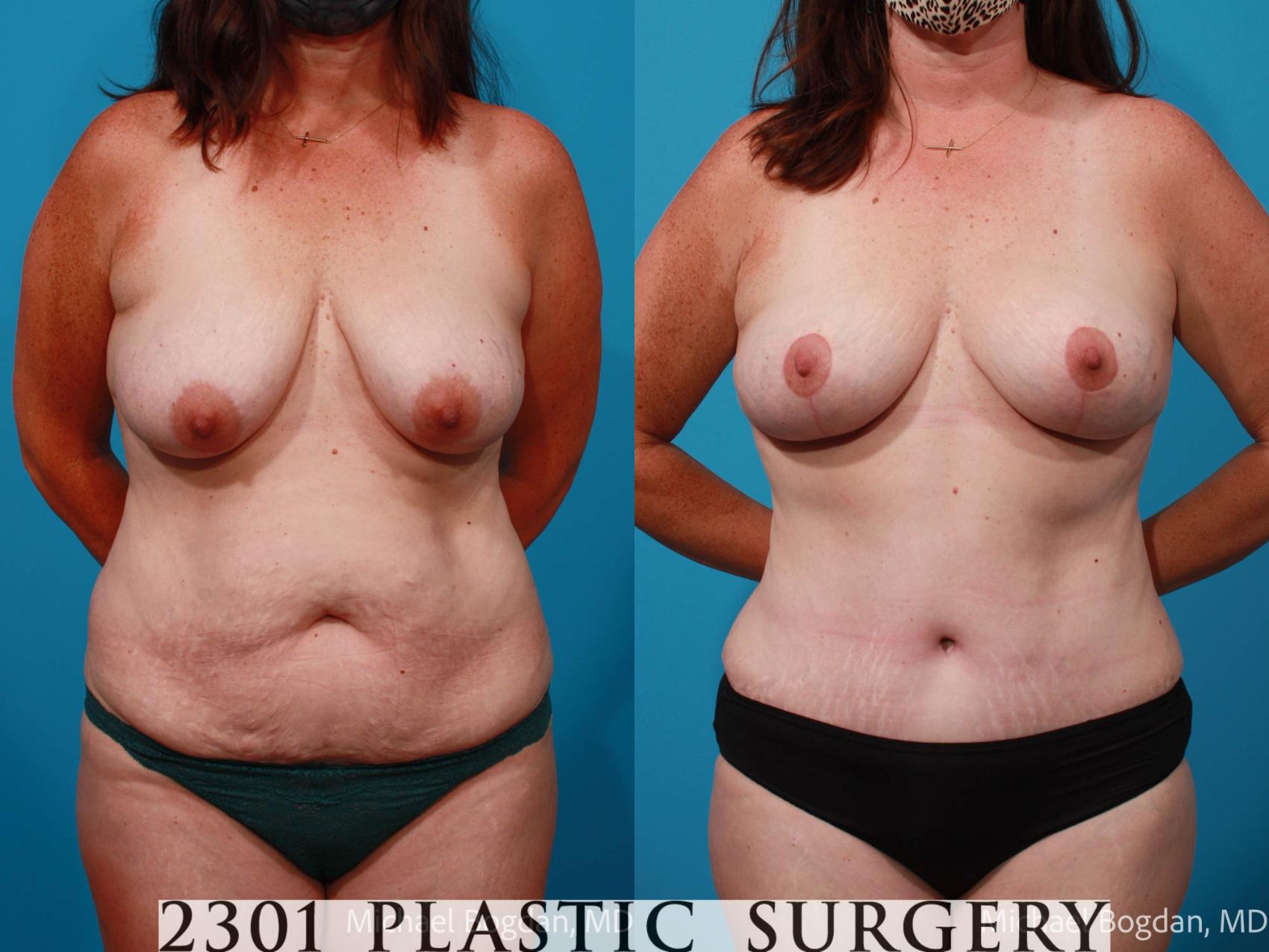 Before & After Tummy Tuck Case 699 Front View in Fort Worth & Frisco, Texas