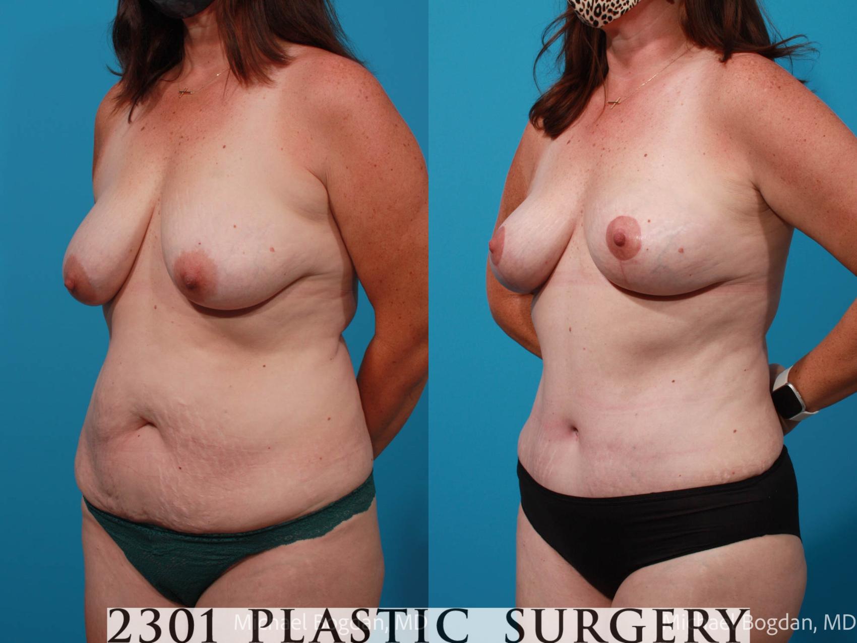 Before & After Tummy Tuck Case 699 Left Oblique View in Fort Worth & Frisco, Texas