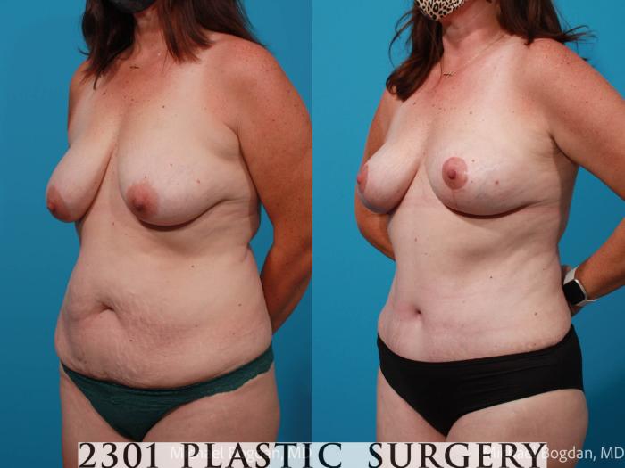 Before & After Tummy Tuck Case 699 Left Oblique View in Fort Worth, Plano, & Frisco, Texas