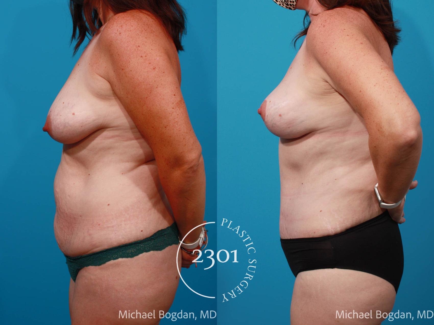 Before & After Mommy Makeover Case 699 Left Side View in Fort Worth, Plano, & Frisco, Texas