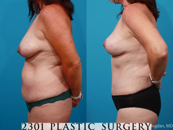 Before & After Mommy Makeover Case 699 Left Side View in Fort Worth, Plano, & Frisco, Texas