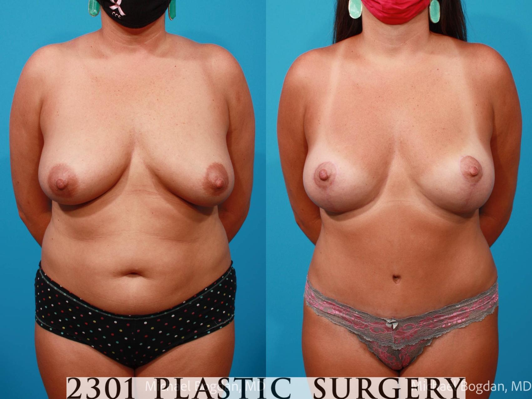 Before & After Tummy Tuck Case 702 Front View in Fort Worth, Plano, & Frisco, Texas