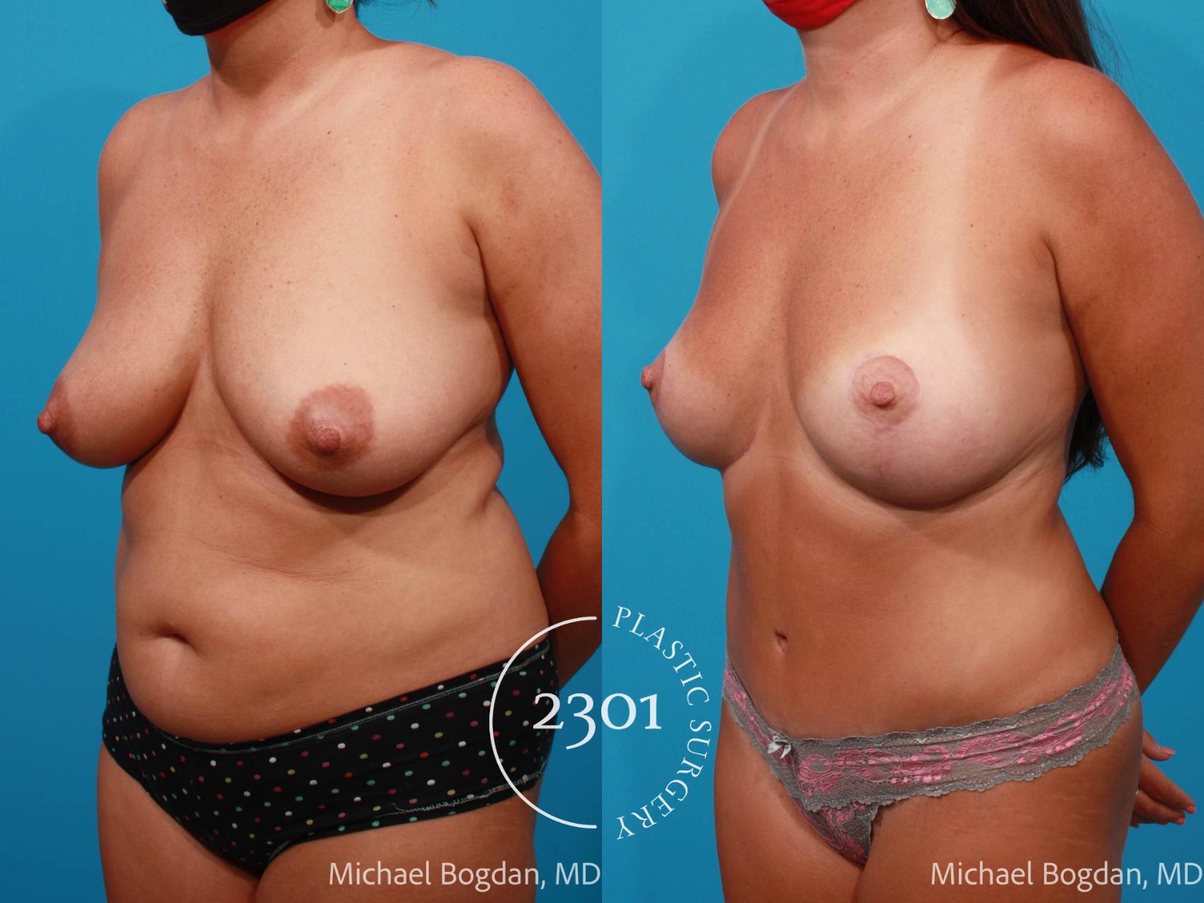 Before & After Tummy Tuck Case 702 Left Oblique View in Fort Worth, Plano, & Frisco, Texas
