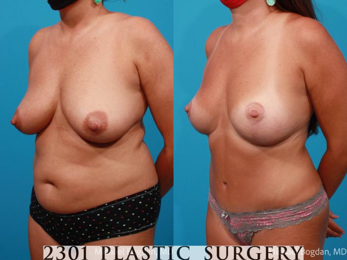 Before & After Tummy Tuck Case 702 Left Oblique View in Fort Worth, Plano, & Frisco, Texas
