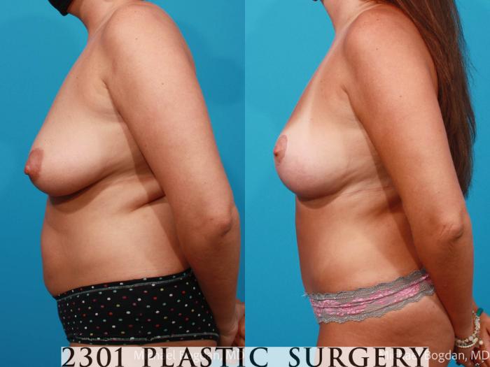 Before & After Tummy Tuck Case 702 Left Side View in Fort Worth, Plano, & Frisco, Texas