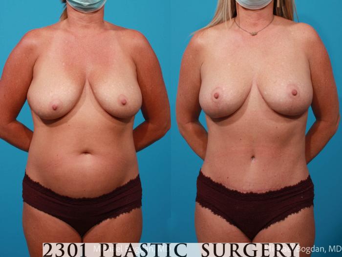 Before & After Mommy Makeover Case 706 Front View in Fort Worth, Plano, & Frisco, Texas