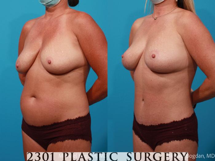 Before & After Breast Lift (Mastopexy) Case 706 Left Oblique View in Fort Worth, Plano, & Frisco, Texas