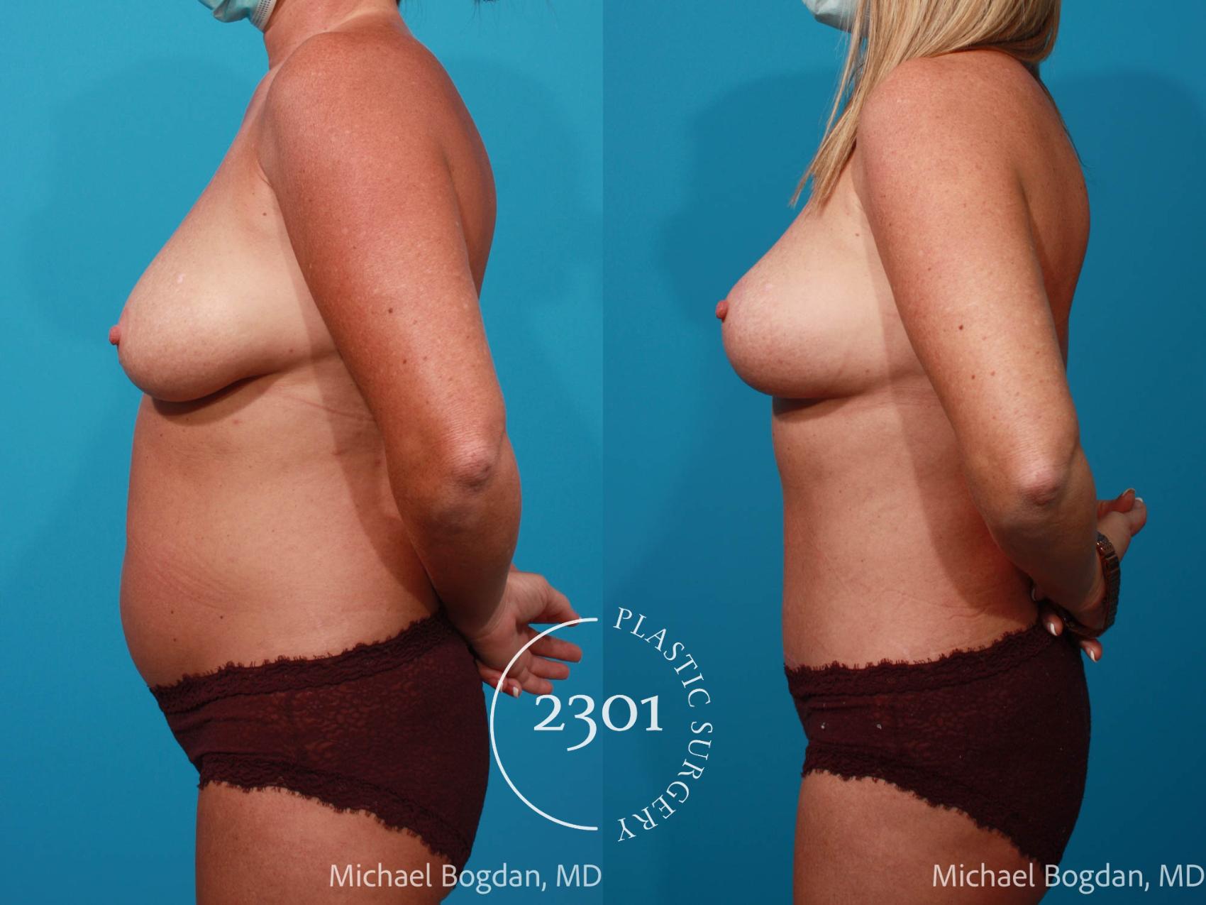 Before & After Tummy Tuck Case 706 Left Side View in Fort Worth, Plano, & Frisco, Texas
