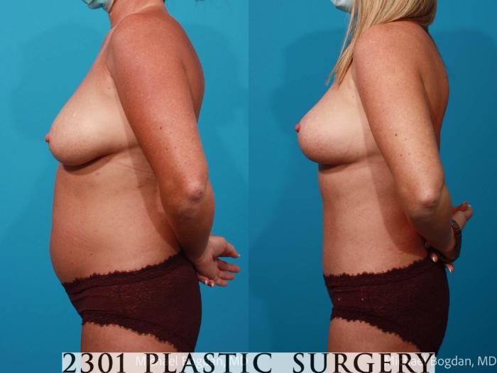 Before & After Breast Lift (Mastopexy) Case 706 Left Side View in Fort Worth, Plano, & Frisco, Texas