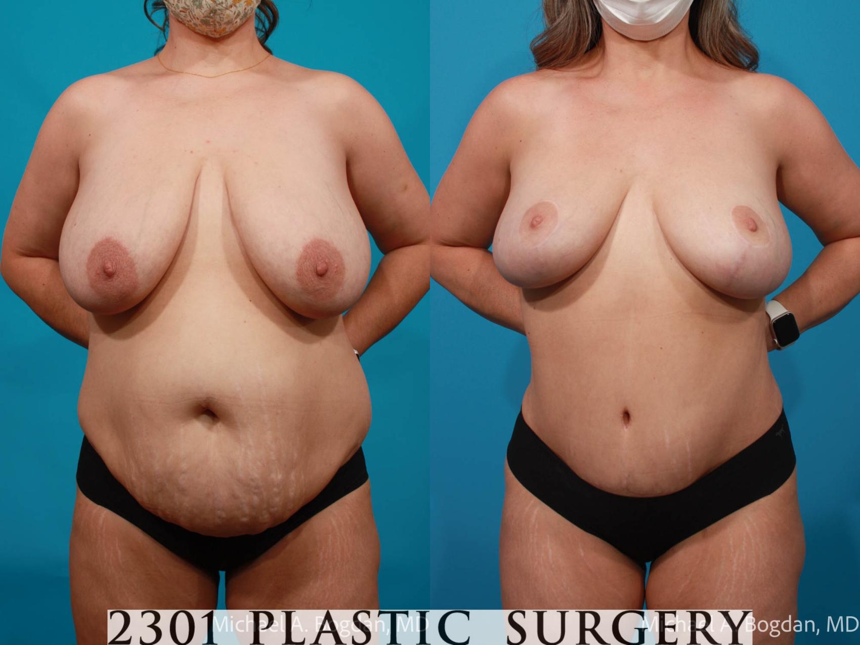 Before & After Tummy Tuck Case 711 Front View in Fort Worth, Plano, & Frisco, Texas