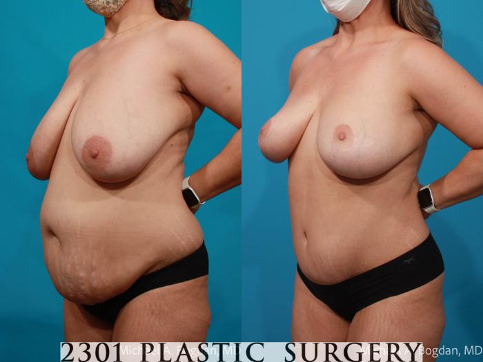 Before & After Mommy Makeover Case 711 Left Oblique View in Fort Worth, Plano, & Frisco, Texas