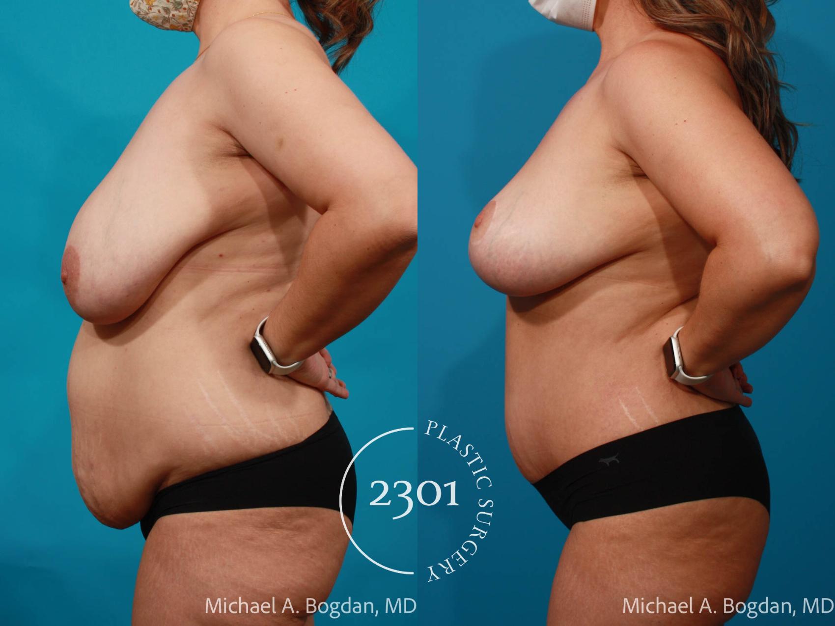 Before & After Mommy Makeover Case 711 Left Side View in Fort Worth, Plano, & Frisco, Texas