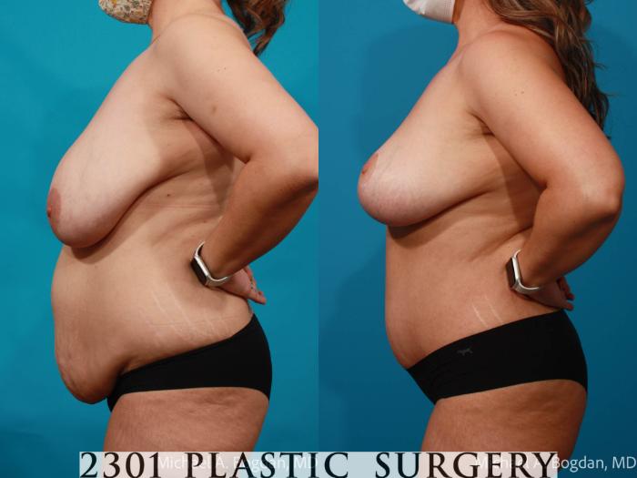 Before & After Mommy Makeover Case 711 Left Side View in Fort Worth, Plano, & Frisco, Texas