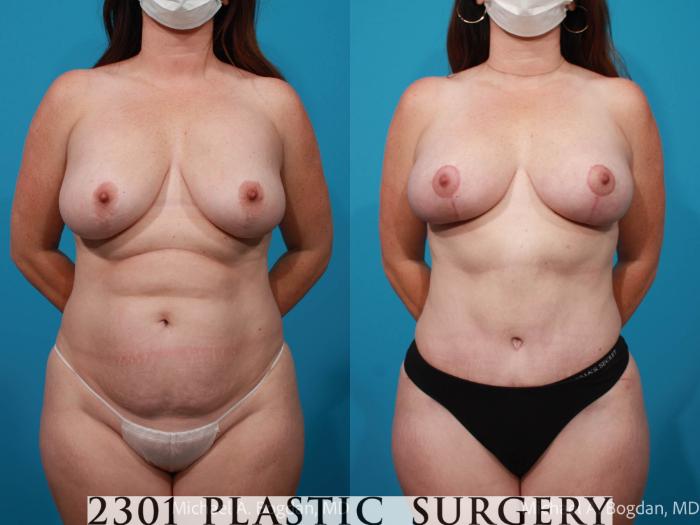 Before & After Tummy Tuck Case 719 Front View in Fort Worth, Plano, & Frisco, Texas