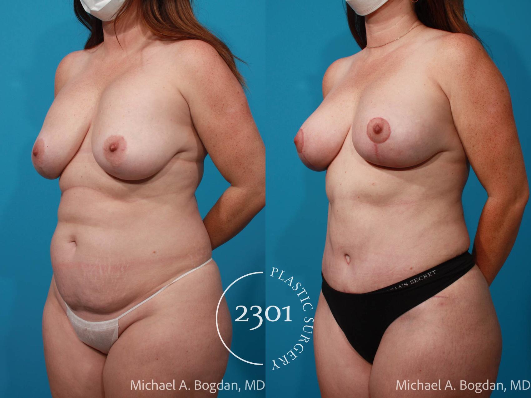 Before & After Mommy Makeover Case 719 Left Oblique View in Fort Worth, Plano, & Frisco, Texas