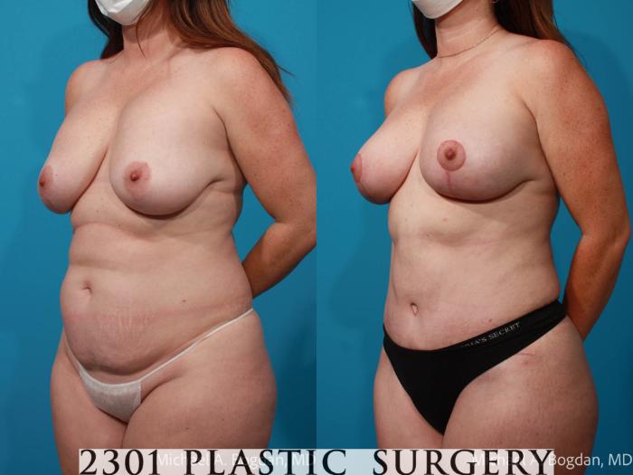 Before & After Tummy Tuck Case 719 Left Oblique View in Fort Worth, Plano, & Frisco, Texas