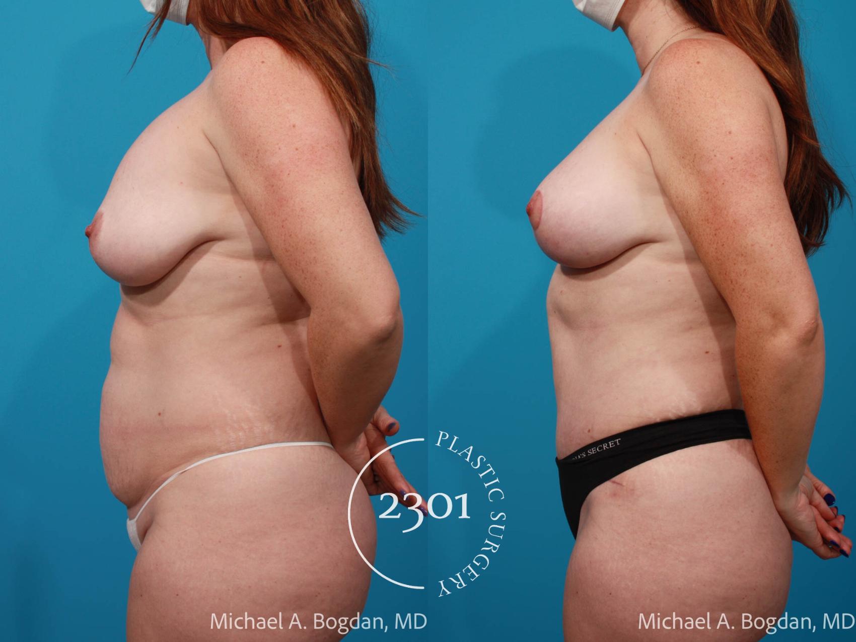 Before & After Mommy Makeover Case 719 Left Side View in Fort Worth, Plano, & Frisco, Texas