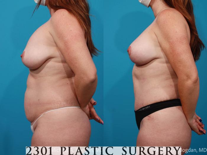 Before & After Tummy Tuck Case 719 Left Side View in Fort Worth, Plano, & Frisco, Texas