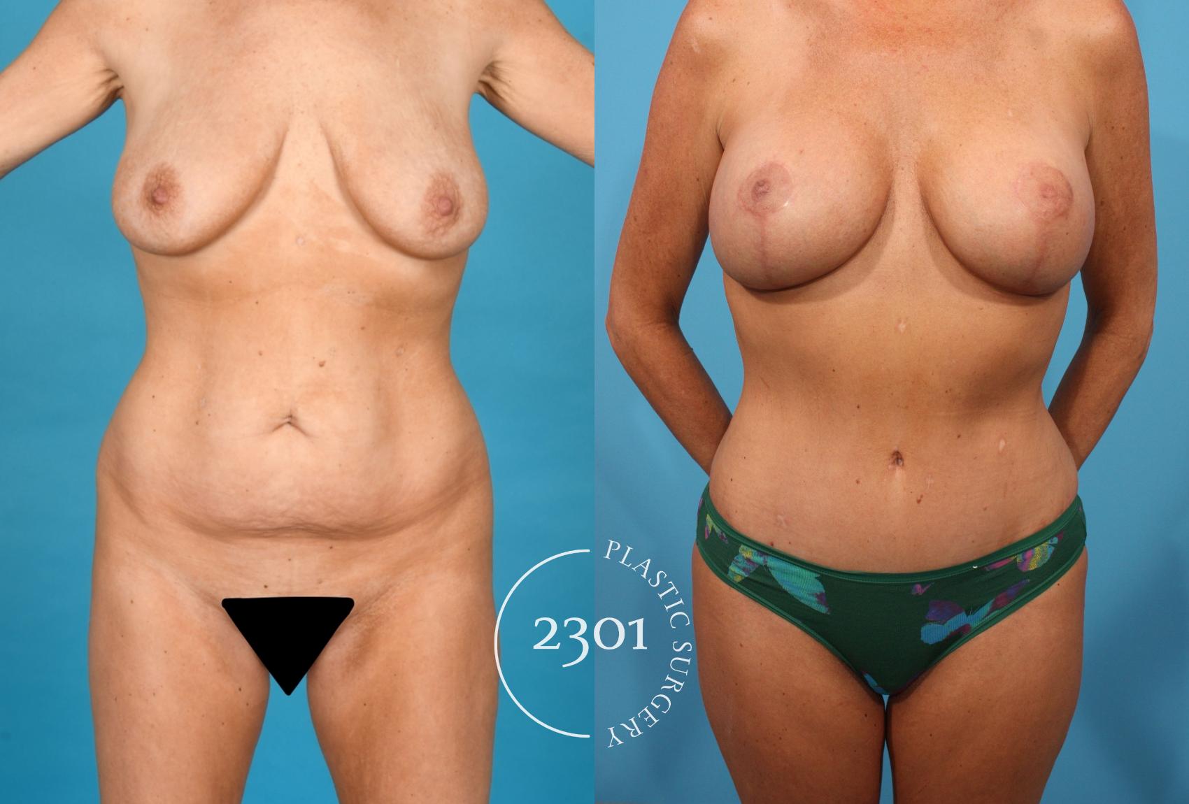 Before & After Tummy Tuck Case 746 Front View in Fort Worth, Plano, & Frisco, Texas