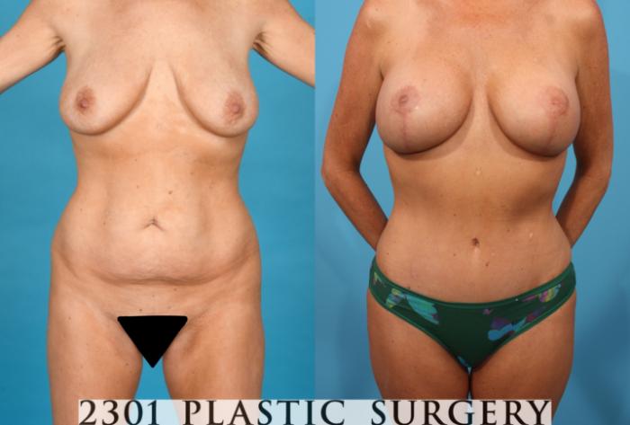 Before & After Tummy Tuck Case 746 Front View in Fort Worth, Plano, & Frisco, Texas