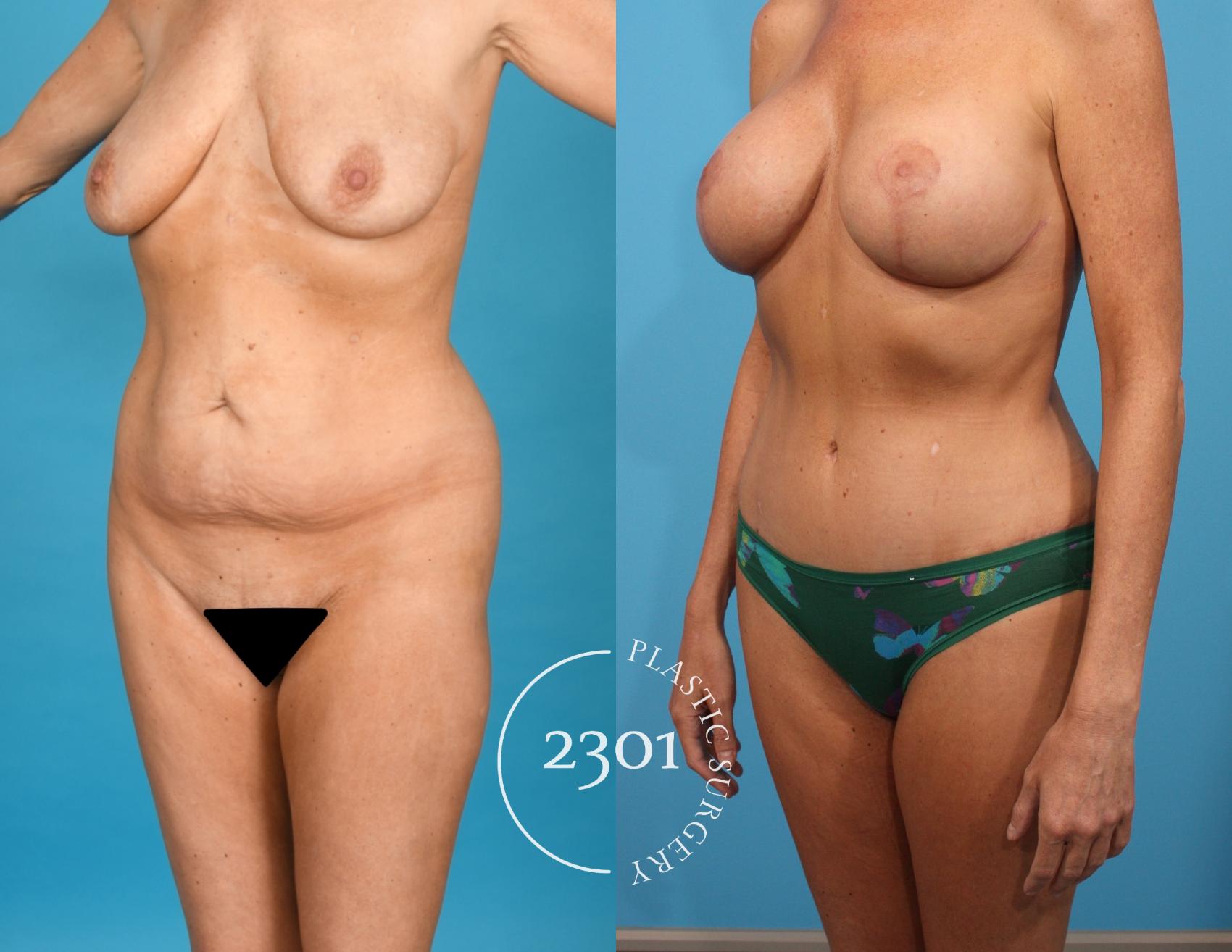 Before & After Tummy Tuck Case 746 Left Oblique View in Fort Worth, Plano, & Frisco, Texas