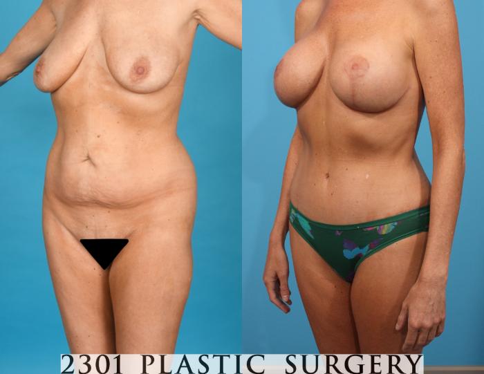 Before & After Post-Bariatric Plastic Surgery Case 746 Left Oblique View in Fort Worth, Plano, & Frisco, Texas