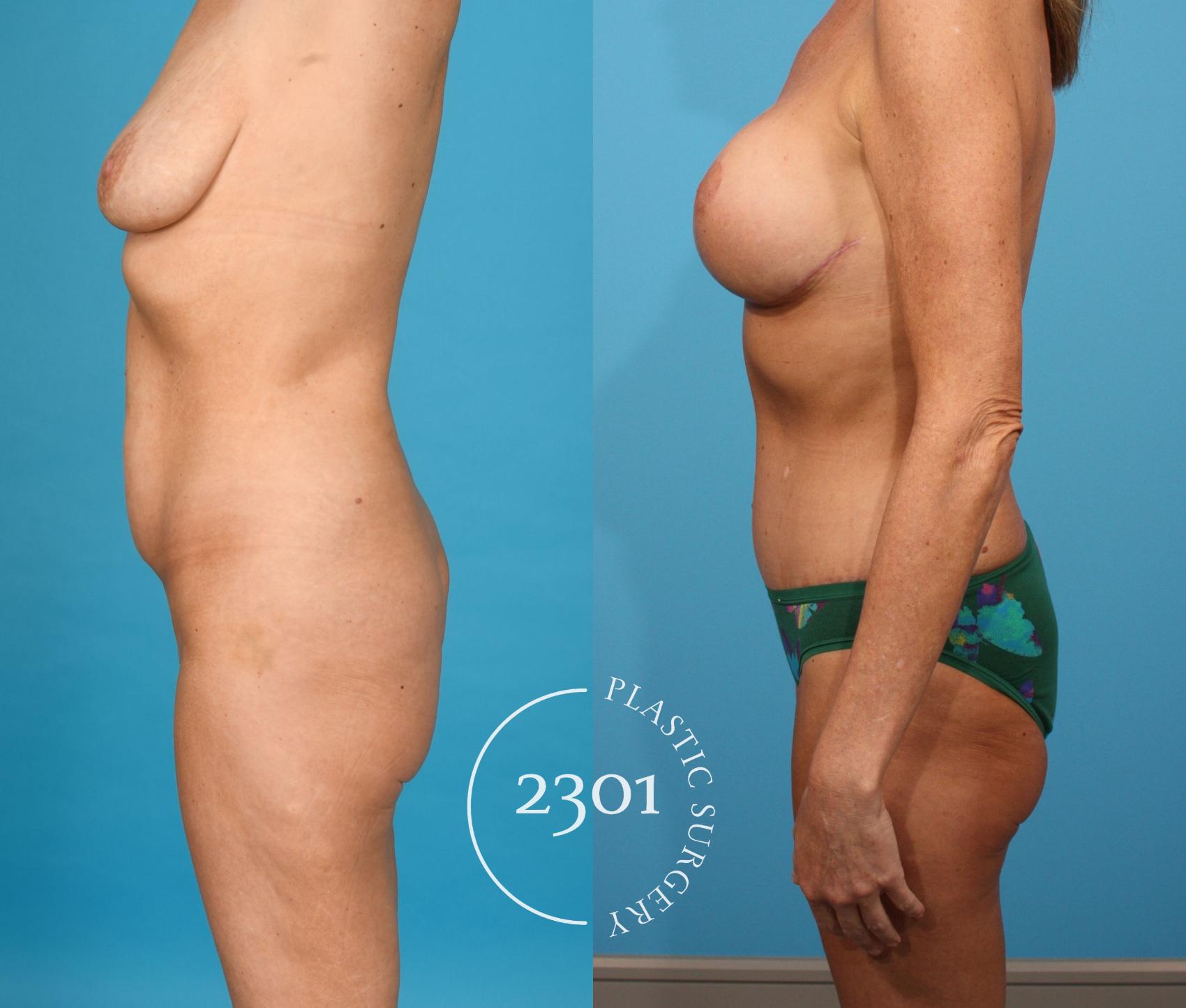 Before & After Tummy Tuck Case 746 Left Side View in Fort Worth, Plano, & Frisco, Texas