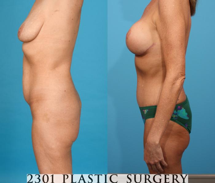 Before & After Post-Bariatric Plastic Surgery Case 746 Left Side View in Fort Worth, Plano, & Frisco, Texas