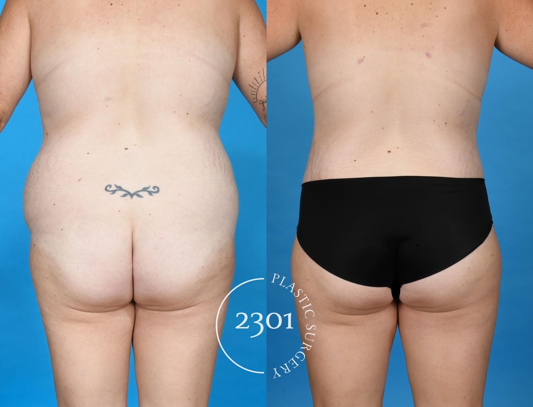 Before & After Mommy Makeover Case 748 Back View in Fort Worth, Plano, & Frisco, Texas