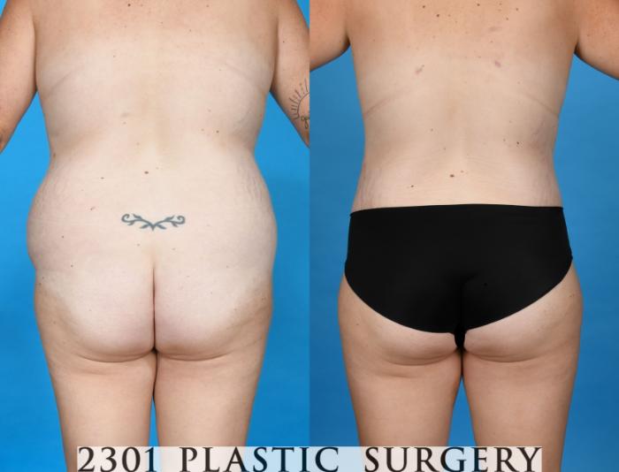 Before & After Tummy Tuck Case 748 Back View in Fort Worth, Plano, & Frisco, Texas