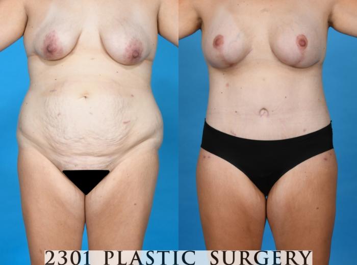 Before & After Tummy Tuck Case 748 Front View in Fort Worth, Plano, & Frisco, Texas