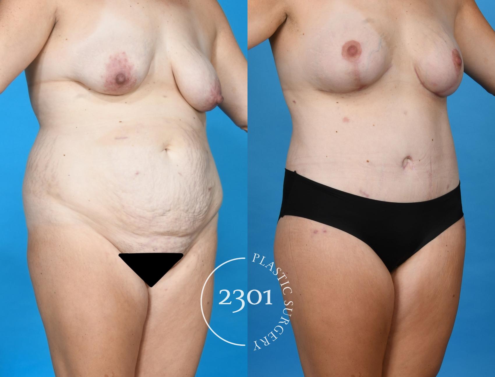 Before & After Mommy Makeover Case 748 Right Oblique View in Fort Worth, Plano, & Frisco, Texas