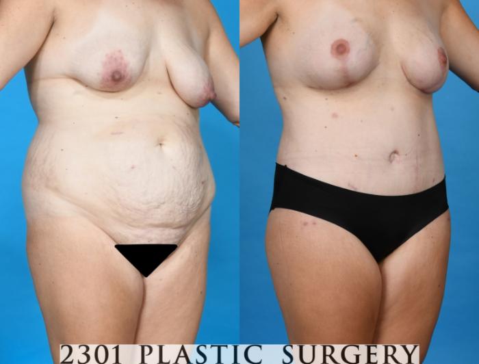Before & After Tummy Tuck Case 748 Right Oblique View in Fort Worth, Plano, & Frisco, Texas