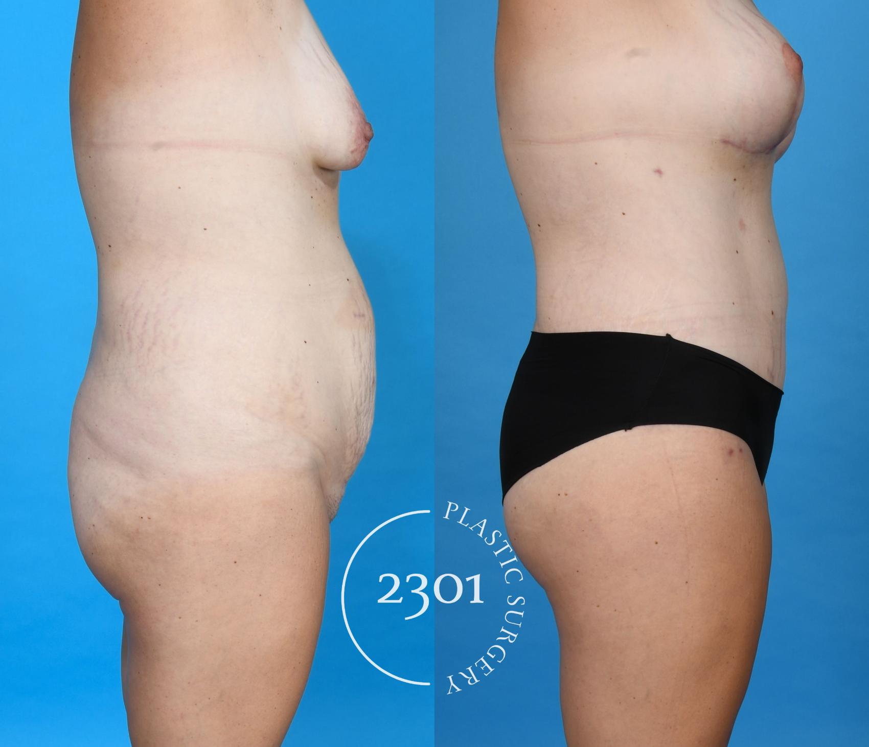 Before & After Mommy Makeover Case 748 Right Side View in Fort Worth, Plano, & Frisco, Texas