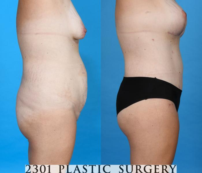 Before & After Tummy Tuck Case 748 Right Side View in Fort Worth, Plano, & Frisco, Texas